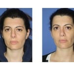 תמונות לפני ואחרי ניתוח אף - 12