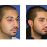 תמונות לפני ואחרי ניתוח אף - 13