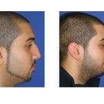 תמונות לפני ואחרי ניתוח אף - 14