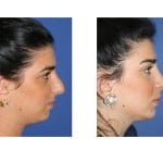תמונות לפני ואחרי ניתוח אף - 19