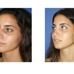 תמונות לפני ואחרי ניתוח אף - 2