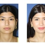 תמונות לפני ואחרי ניתוח אף - 6